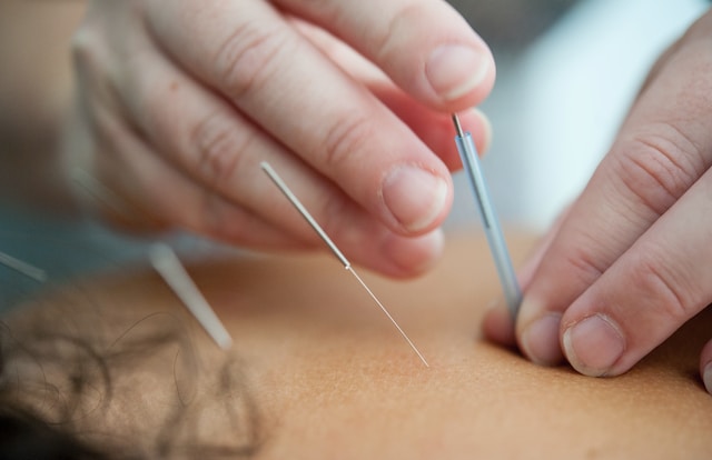 Les bienfaits de l&rsquo;acupuncture en parallèle d&rsquo;un accompagnement avec un psychologue du travail